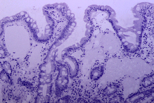Sample from a human with Lymphangiectasia. The villi are short and squat compared to the normal finger-like villi shown at the top of this page. Note the large white areas within the intestinal microvillus shown. These are dilated lacteals as described.