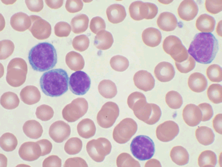 The large purple cells are circulating malignant lymphocytes (leukemia cells). This is actually a human sample.