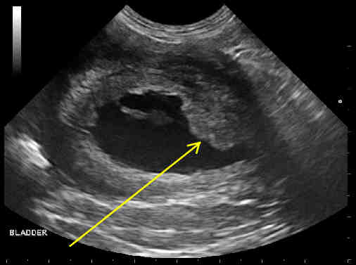 Ultrasound image of a Transitional Cell Carcinoma in a dog's bladder neck.