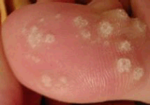 a human toe with several viral warts.