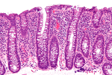 Large intestinal lining heavily infiltrated with lymphocytes