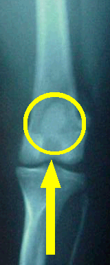 normal knee