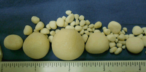 Image of Canine Struvite Bladder Stones in various sizes