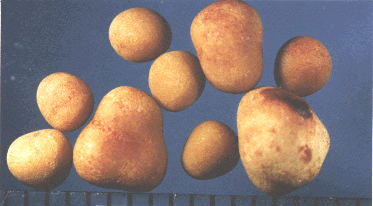 picture of gall stones of various sizes