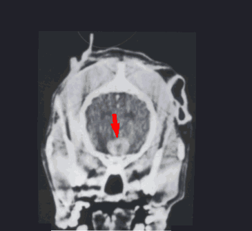 Pituitary Macroadenoma