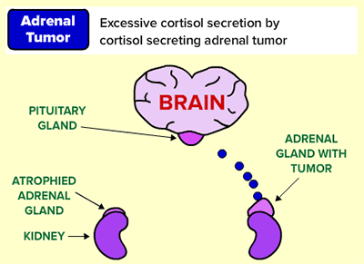 over productive adrenal gland