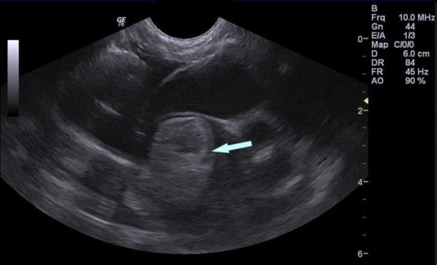 Arrow shows a large clot in the left atrium of a cat with a saddle thrombus.