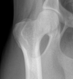 normal hip - femoral head fits snugly inside acetabulum