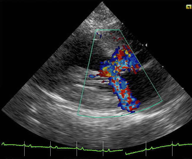 Echocardiographic cross section of a heart with hypertrophic cardiomyopathy