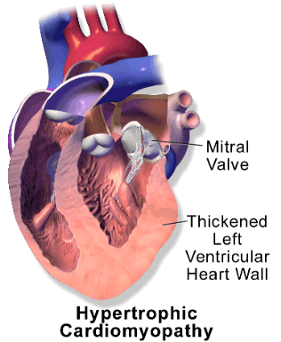 Heart with hypertrophic cardiomyopathy. Note the thickened muscle walls.