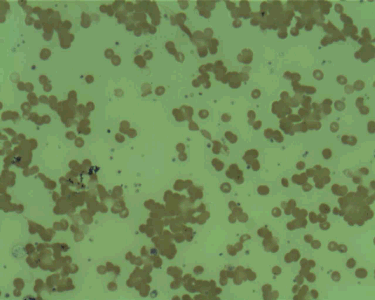 Photo showing autoagglutinating red blood cells
