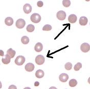 Graphic showing arrows point to spherocytes