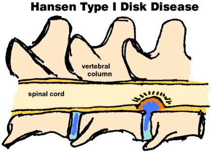 Graphic showing Type I Disk Disease