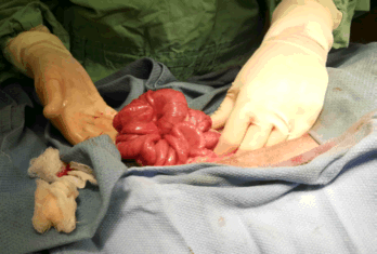 Plicated bowel with a linear foreign body inside