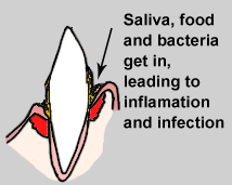 illustration showing plaque collecting in gingival sulcus