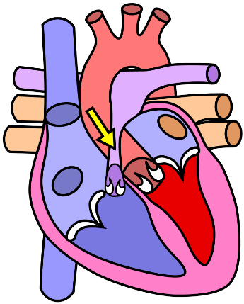 illustration showing pulmonic stenosis