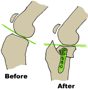 In the TPLO surgery, the plateau (flat top) of the tibia is carved away and repositioned