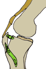 The tibial crest where the patellar ligament attaches is angled